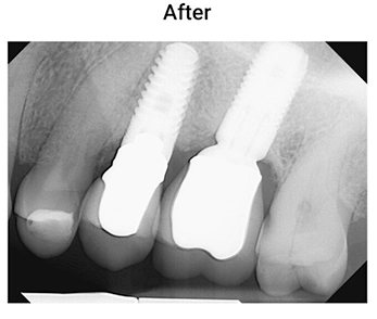 Chronic-Pain-Scottsdale-AZ-Dental-X-rays-Before-Slide
