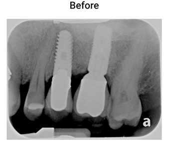 Chronic-Pain-Scottsdale-AZ-Dental-X-rays-Before-Slide